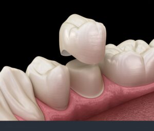 teeth crowns Highlands Ranch